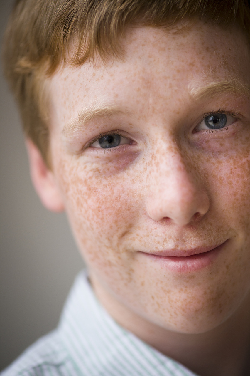 激光祛斑#   男生脸上出现雀斑是一种常见的皮肤问题,许多人都想