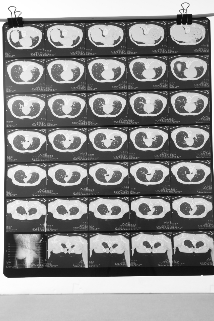 1,纤维灶,这个一般是指良性病变,特指慢性炎症后遗灶,就是说这个地方