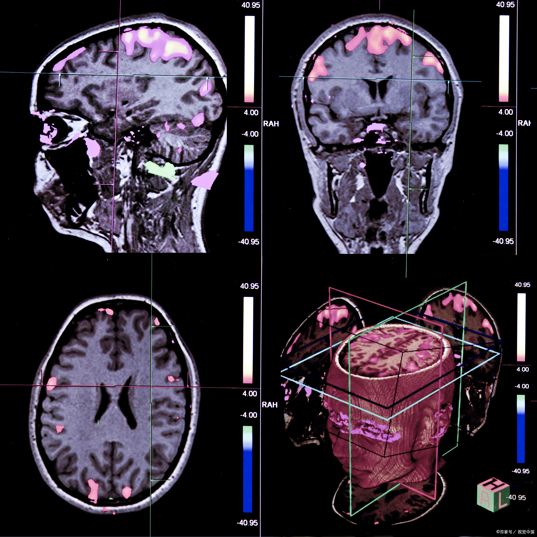 今天有个患者在进行脑部检查的时候发现存在双侧额顶叶白质异常