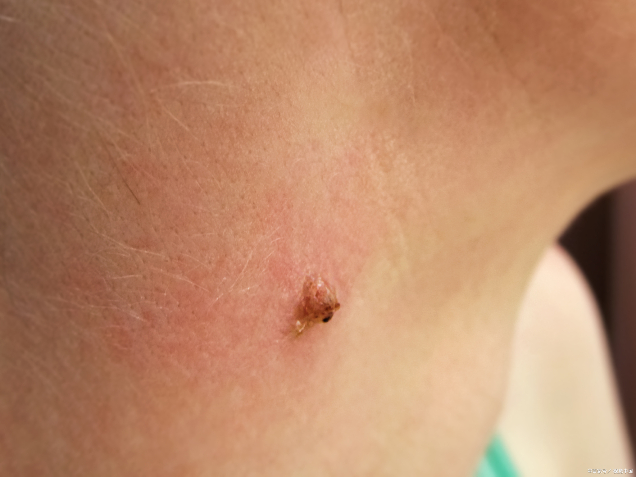 身体上出现的"小肉粒"是什么?医生提醒别乱揪