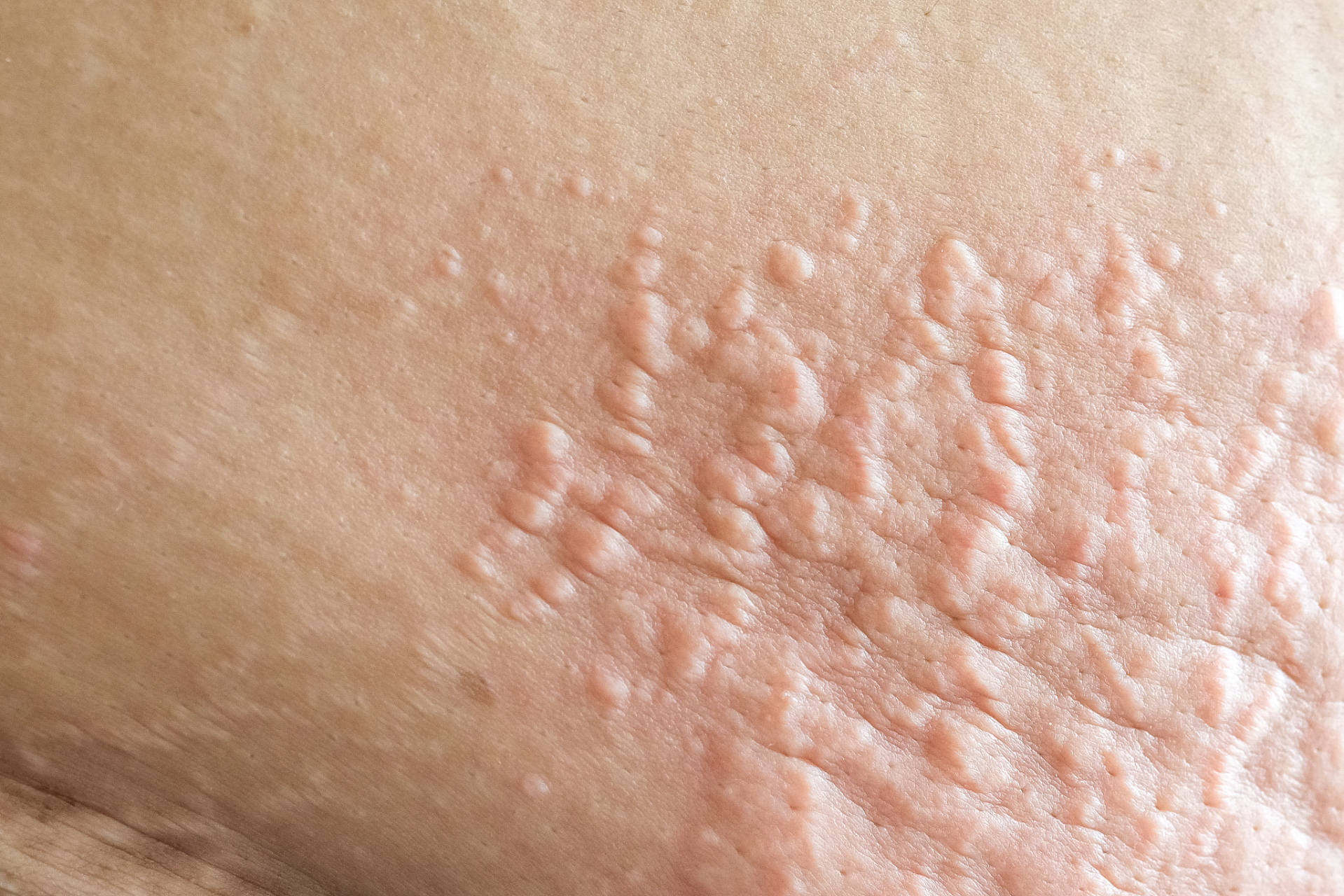 最近三阳越来越普遍,大家要保护好自己,做到勤洗手