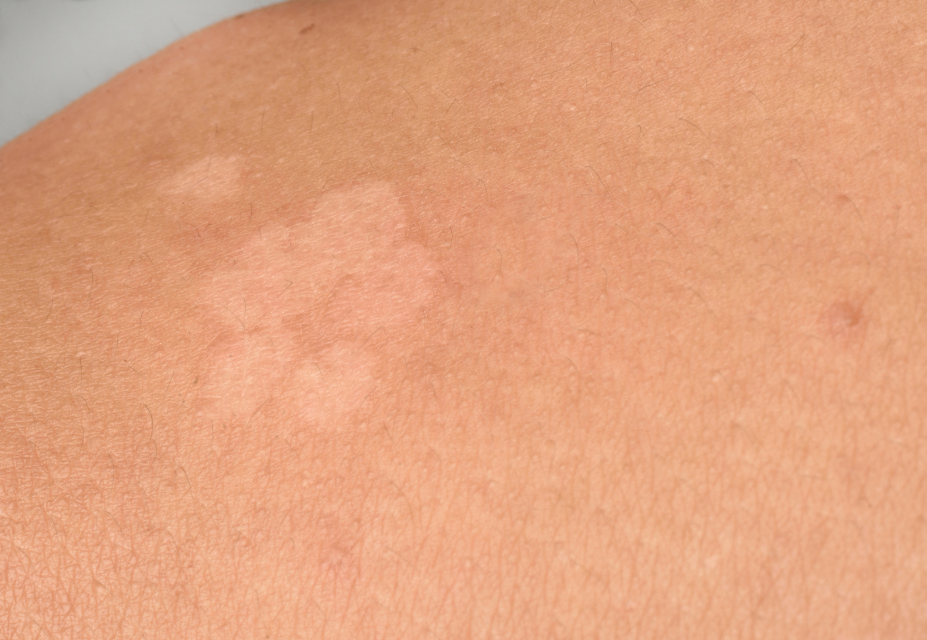 上长了白斑要根据出现的原因进行针对性处理,常见的原因有包茎,包皮垢