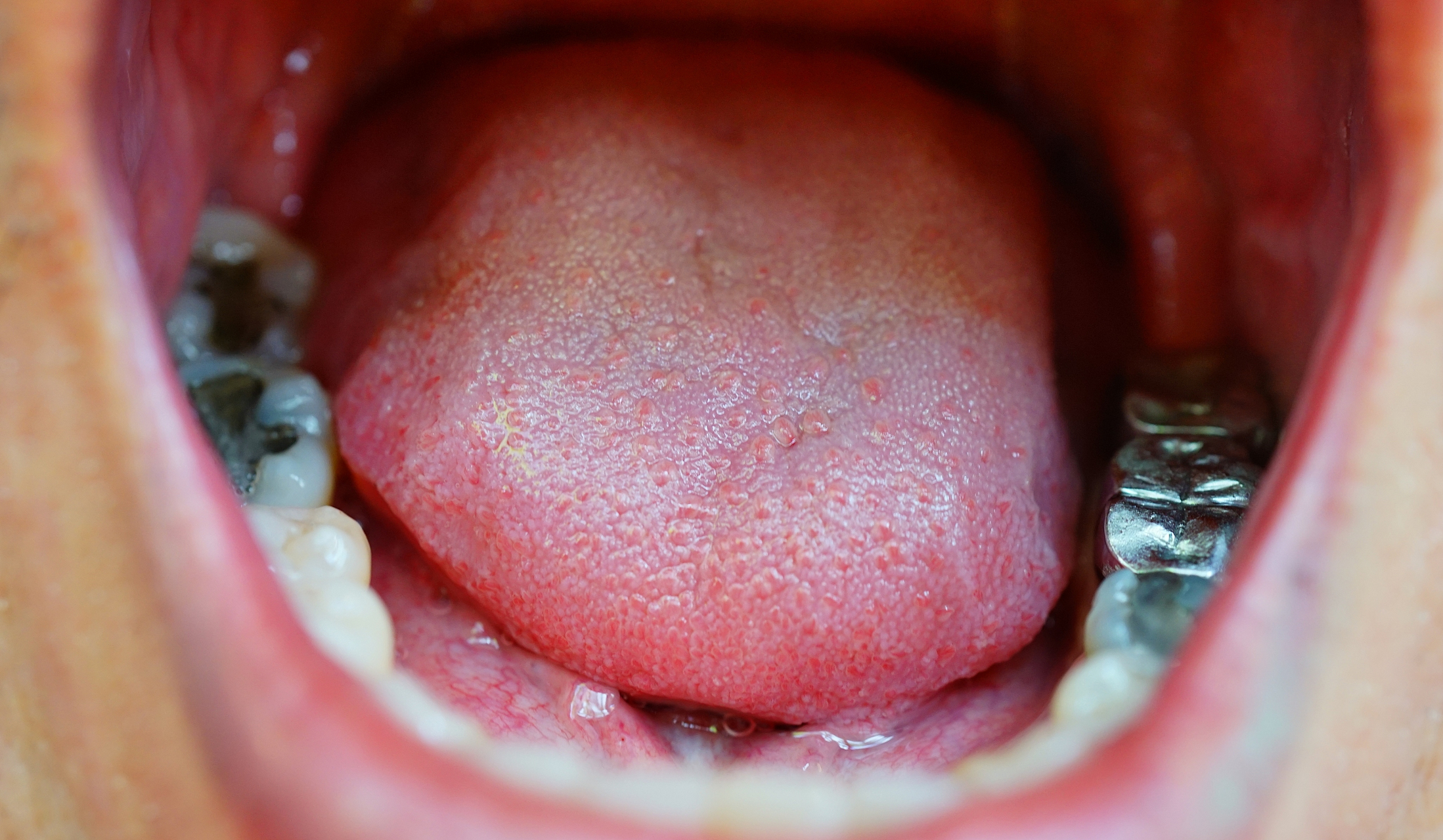 刺,指舌乳头突起如刺,摸之棘手  的红色或黄黑色点刺,称为芒刺舌.