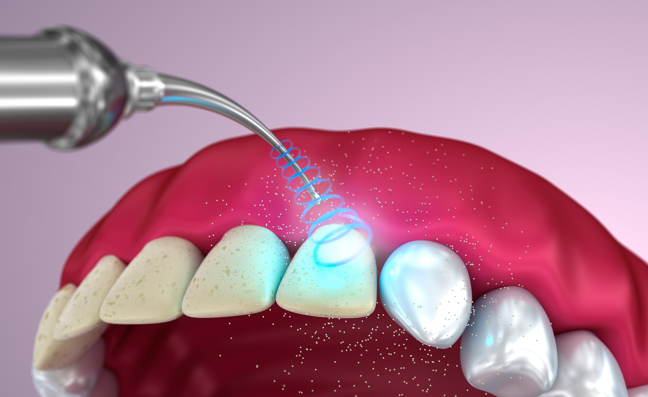 喷砂洁牙和普通洁牙的区别 #洗牙#  1.