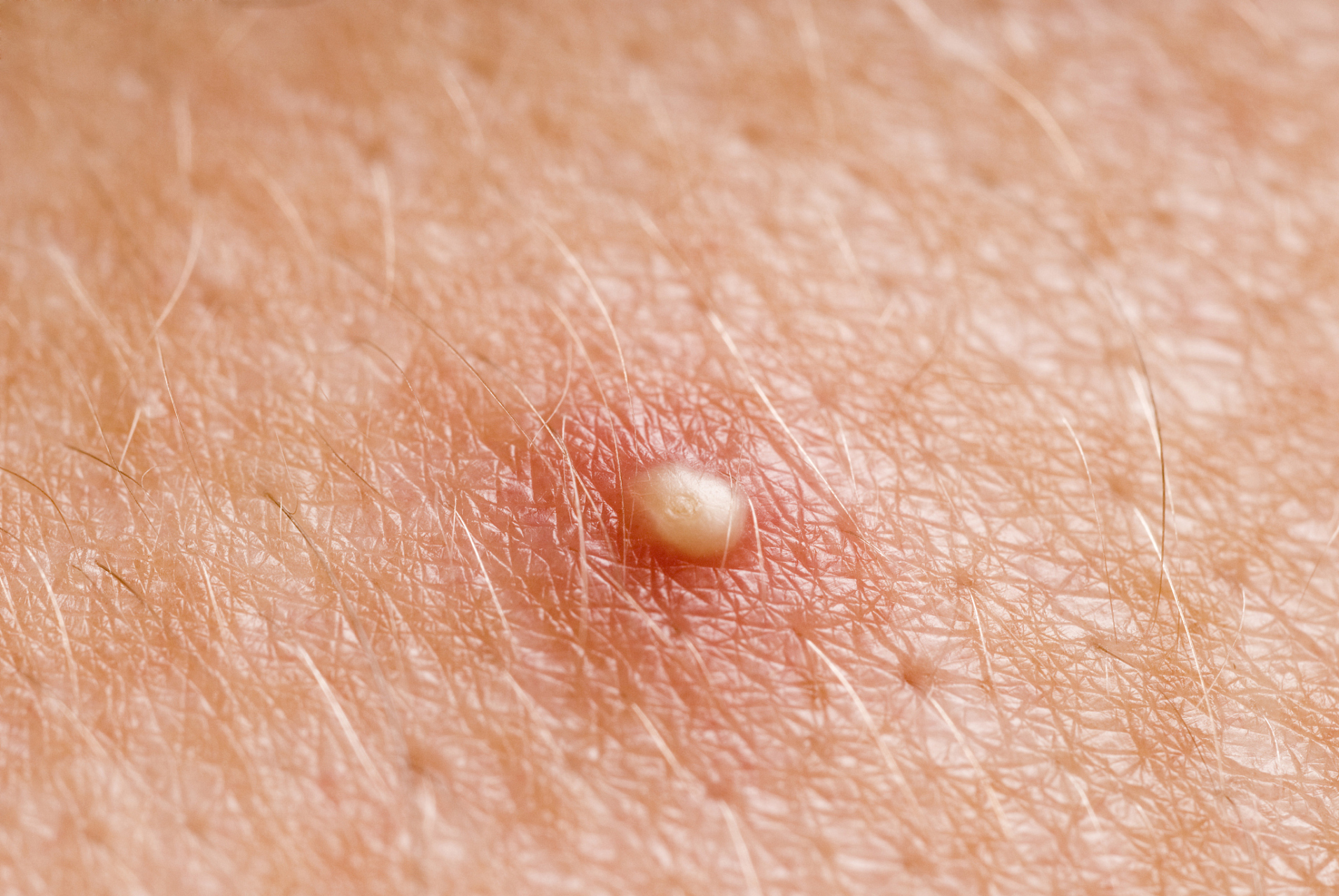 男性丁丁上长了小疙瘩一般是哪些原因导致的?