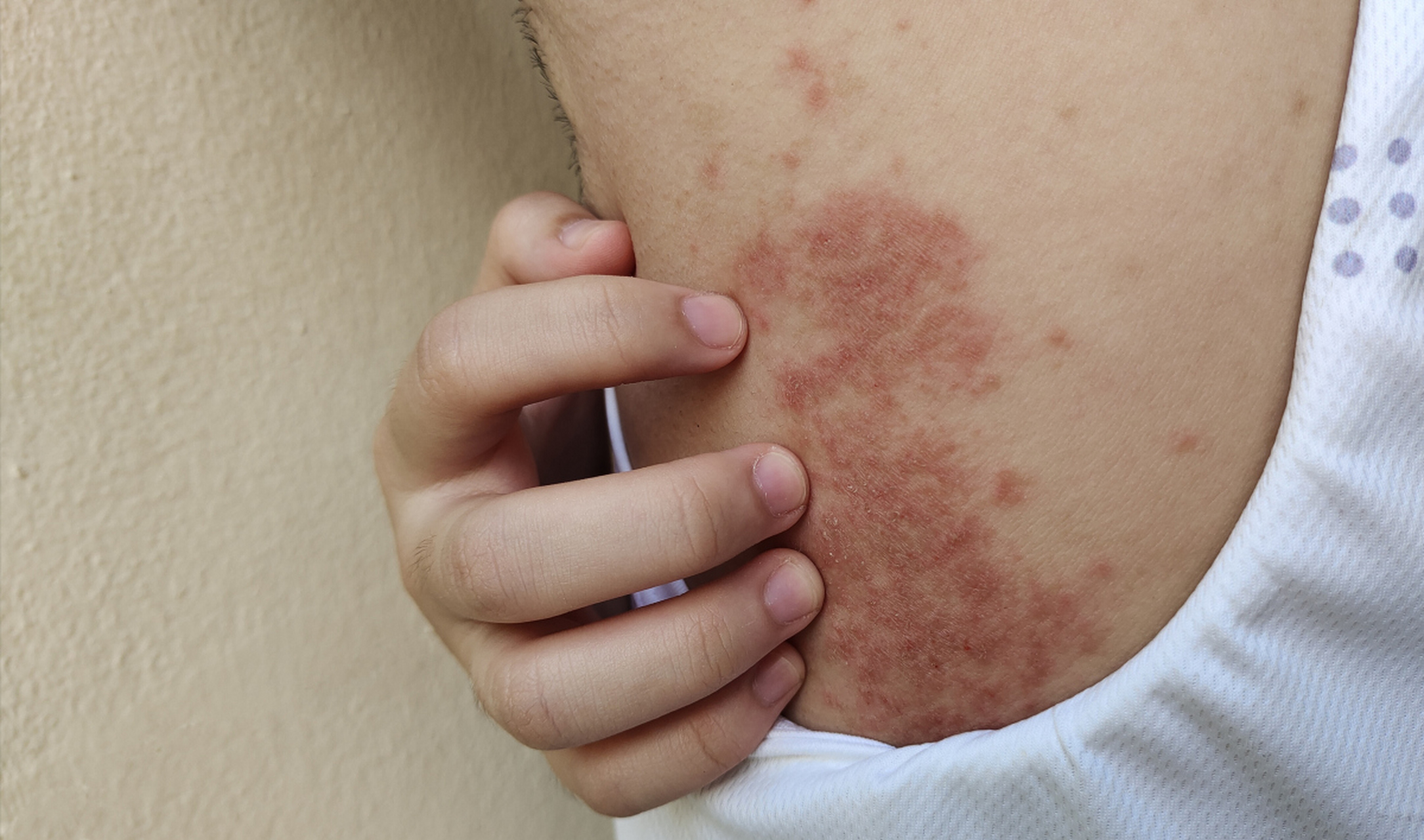 荨麻疹反反复复总不好,怎么回事呢?