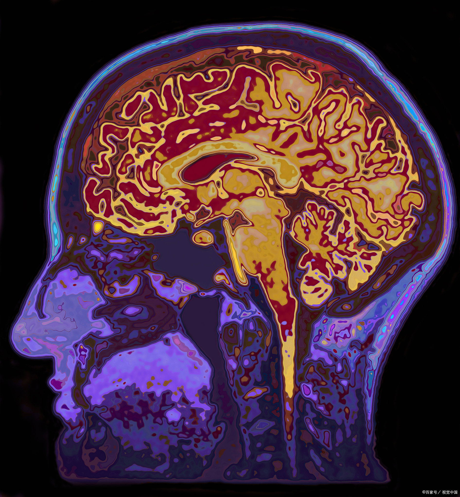 小脑萎缩,这一看似遥远的医学名词,其实离我们并不遥远.