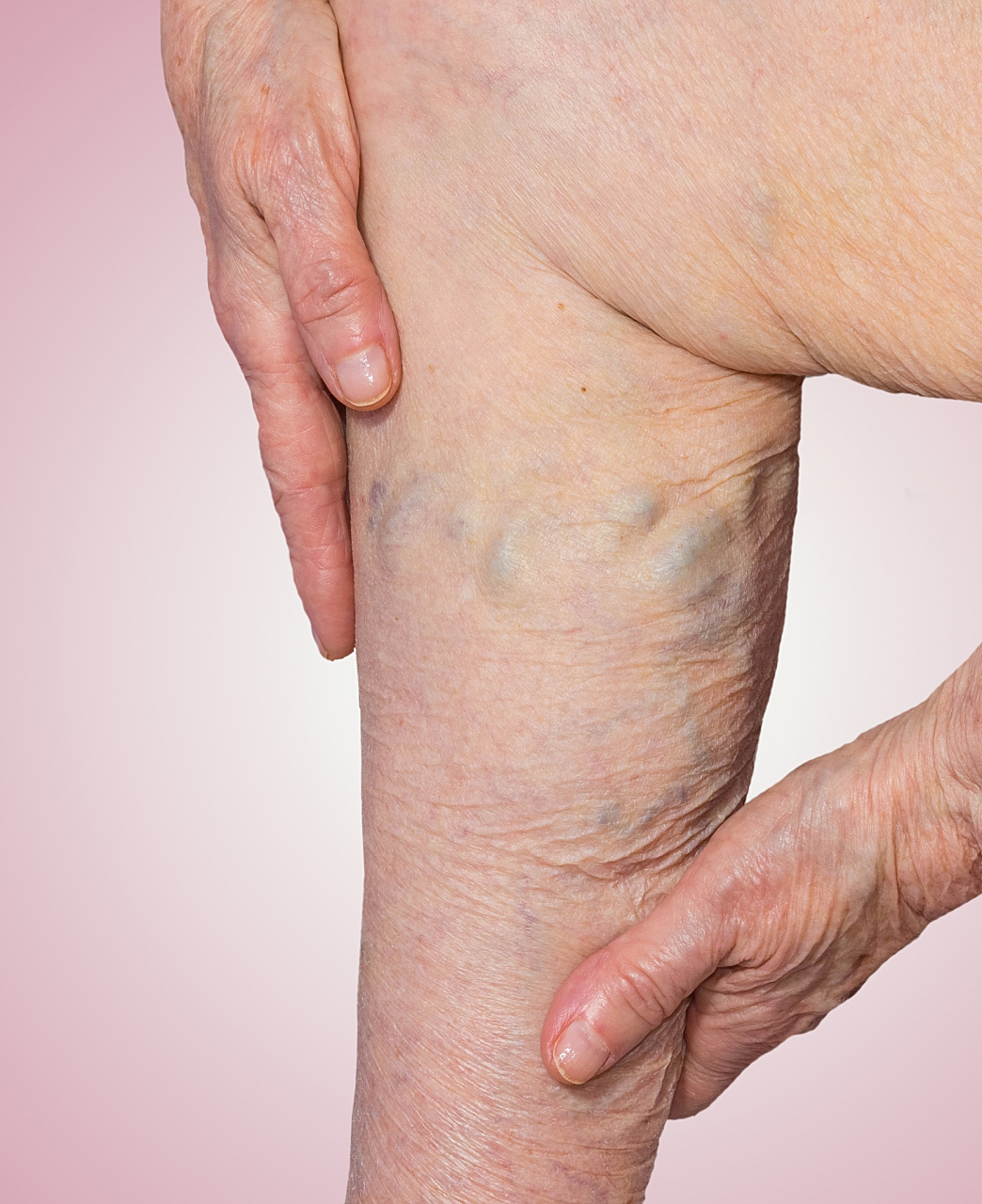 硬皮病会导致哪些疾病呢?  一,消化系统病变.  二,心脏病变.