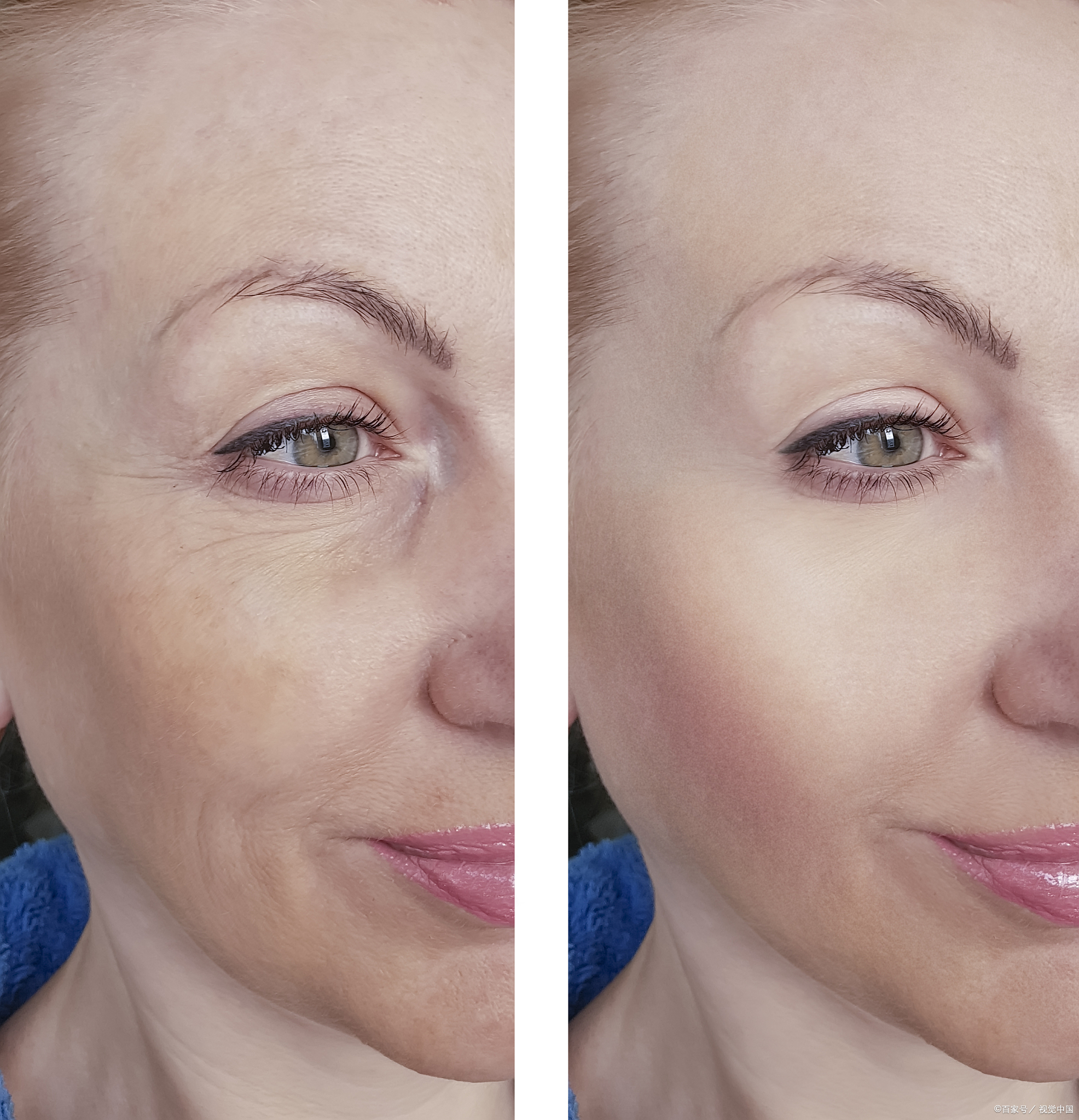 1 胶原蛋白面部松垮紧致对比横向皮肤松弛