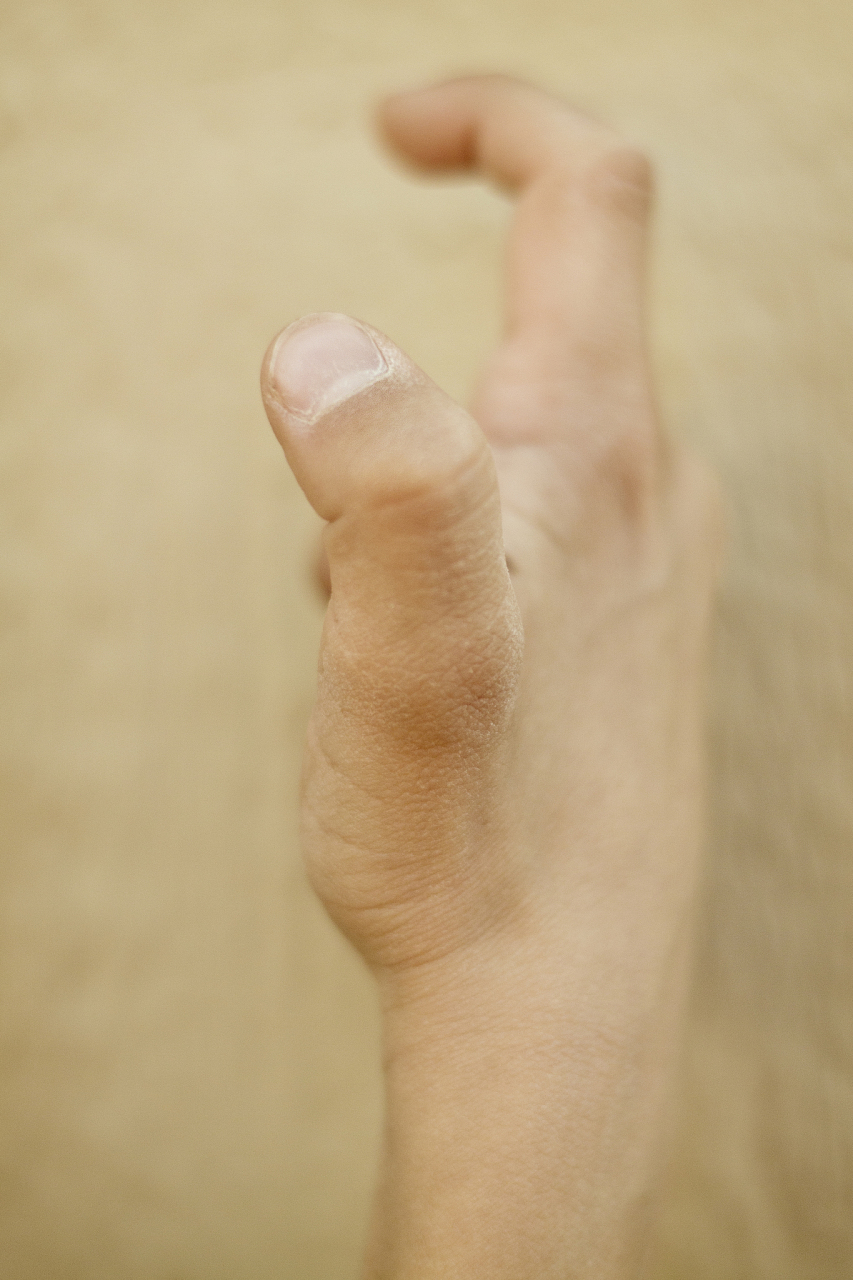 大拇指关节伸弯卡顿还疼什么原因	大拇指关节伸弯卡顿还疼可能是受凉,