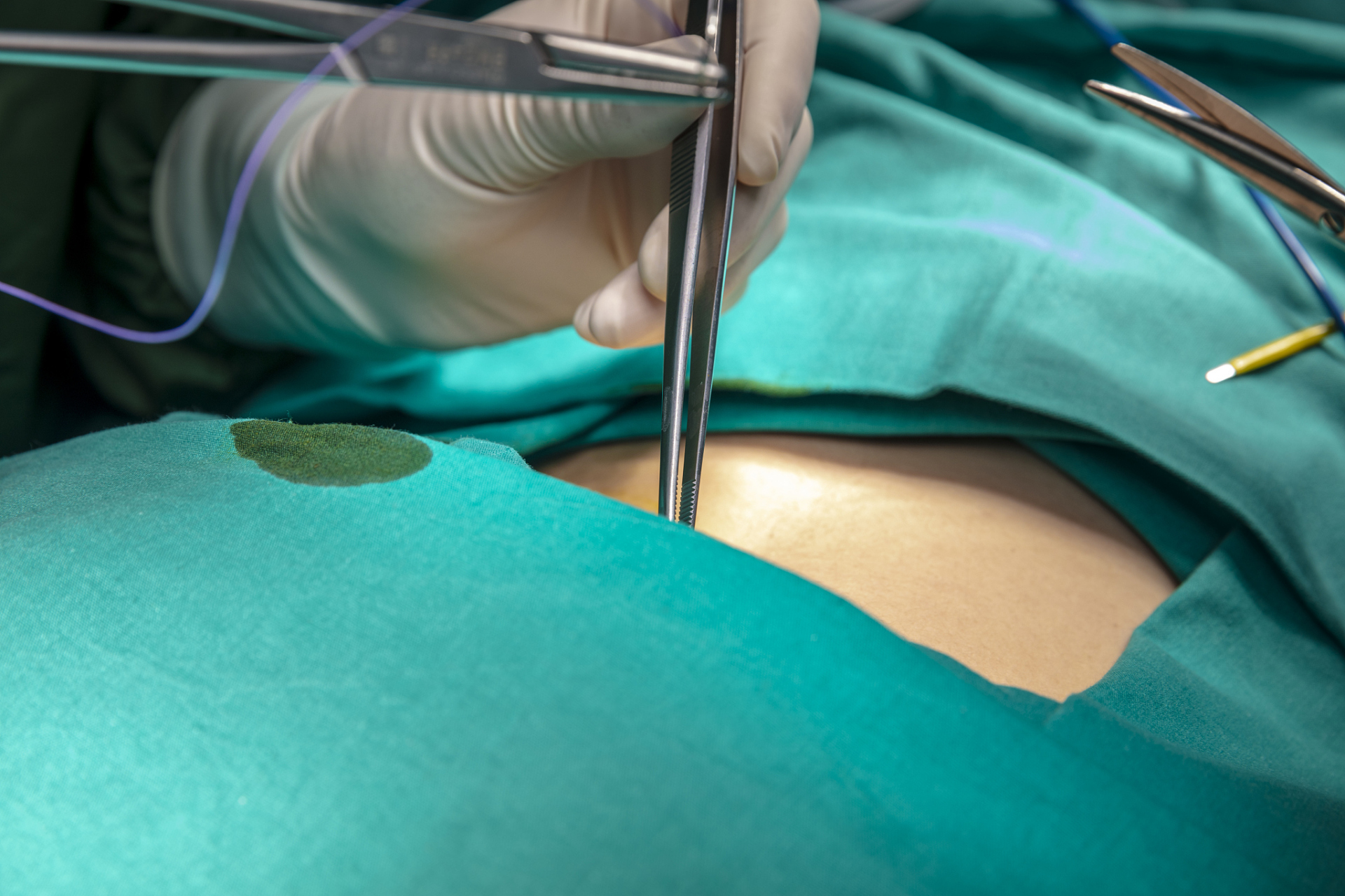 保乳术,全称为保留乳房的乳腺癌切除术,是一种创新的手术方式,旨在