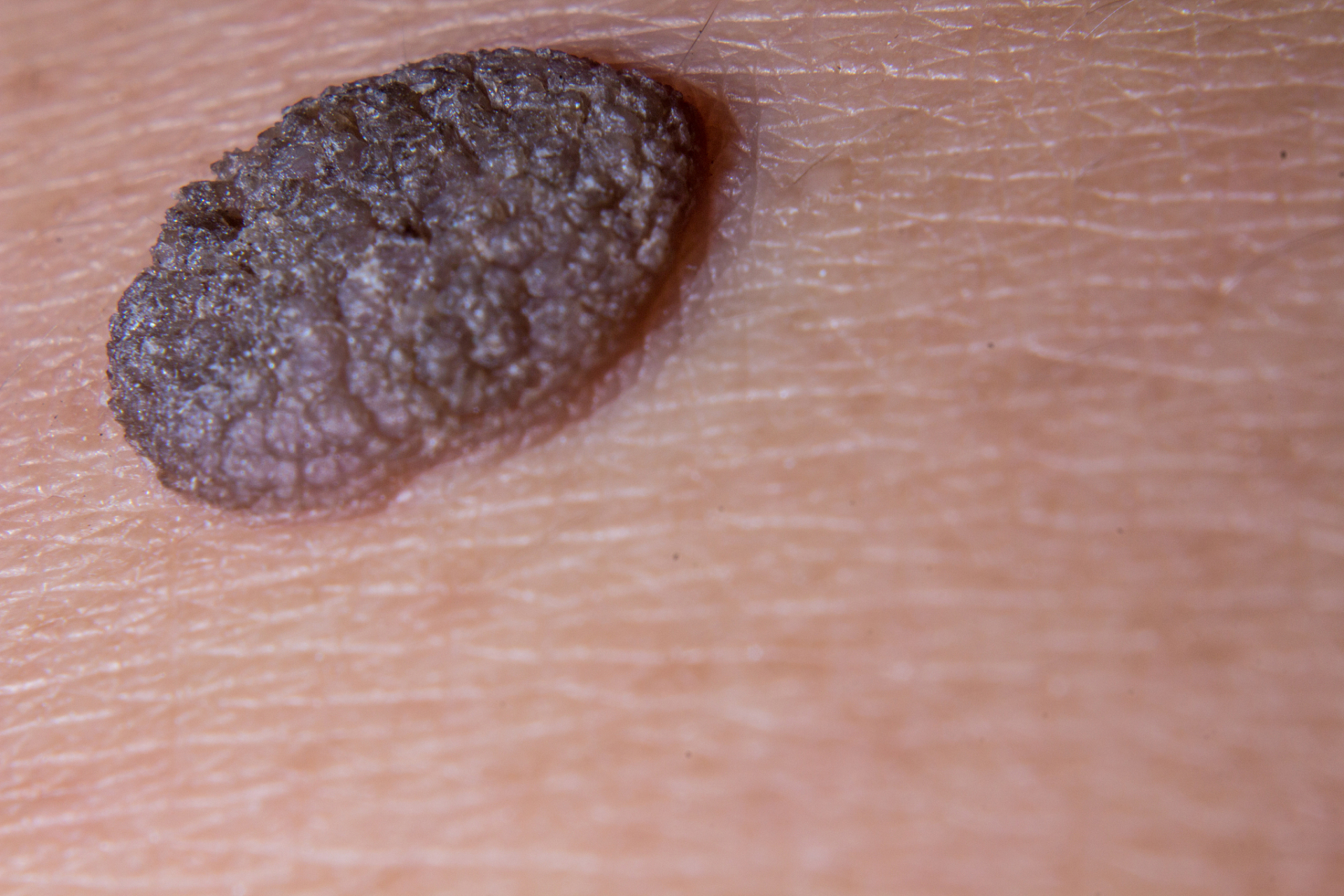 巨大黑痣癌变黑色素瘤的概率有多大? 巨大黑色素痣癌变的概率为6.