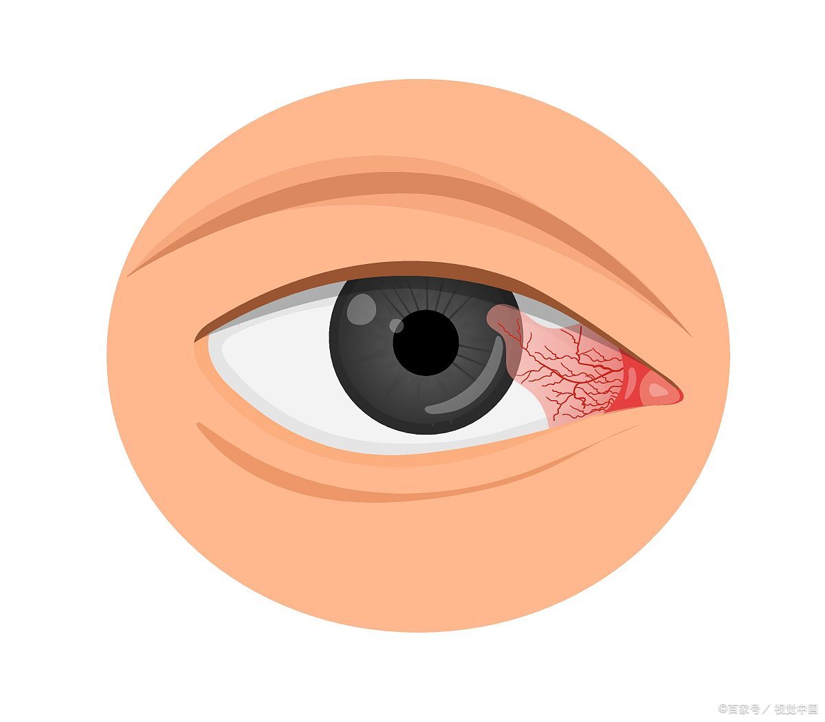 武汉爱尔眼科医院# #翼状胬肉# #肠息肉癌变有哪些症状
