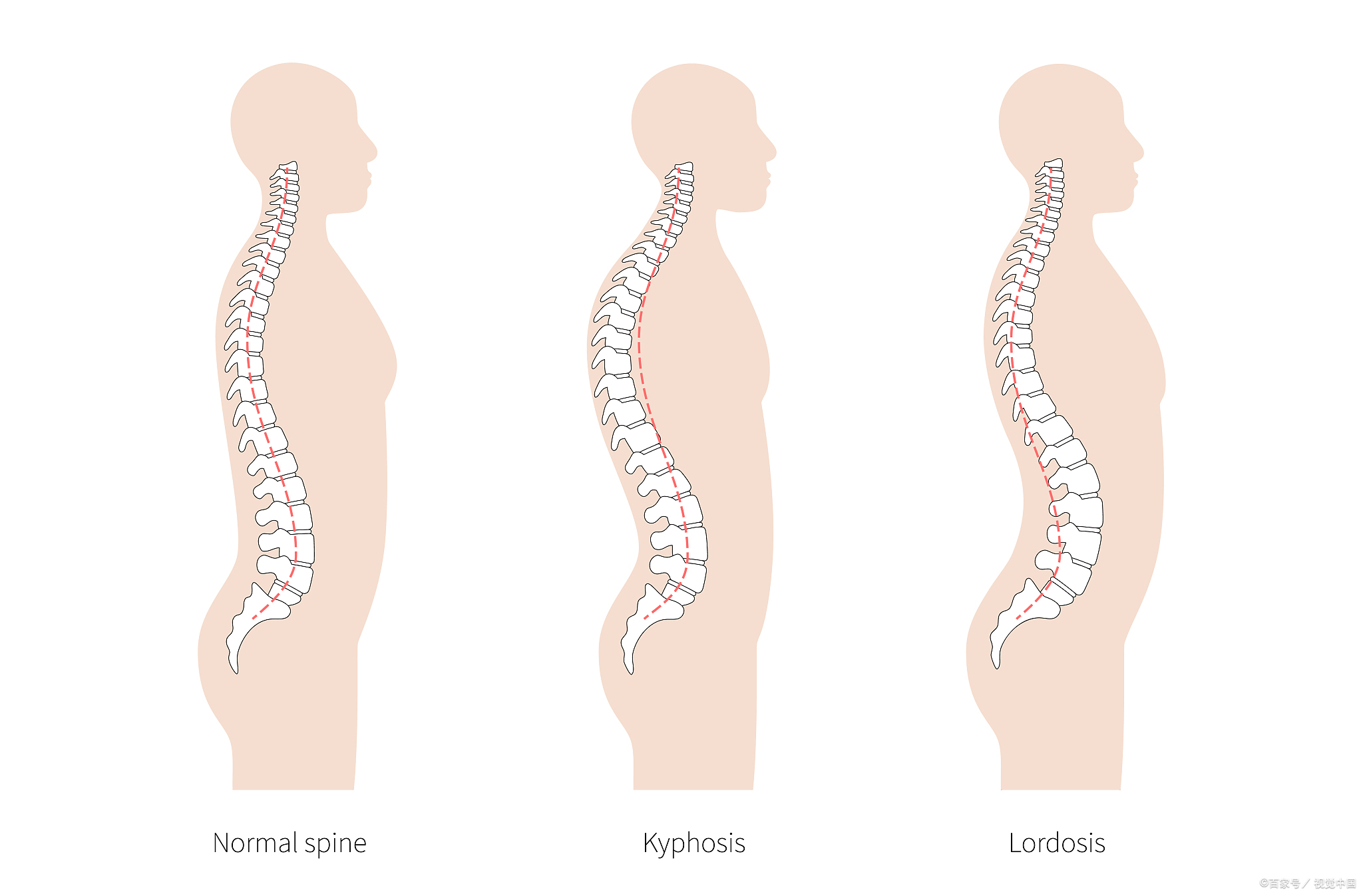 侧弯图片脊椎侧弯对比图lordosis脊柱过分前倾会导致腹主动脉变形吗