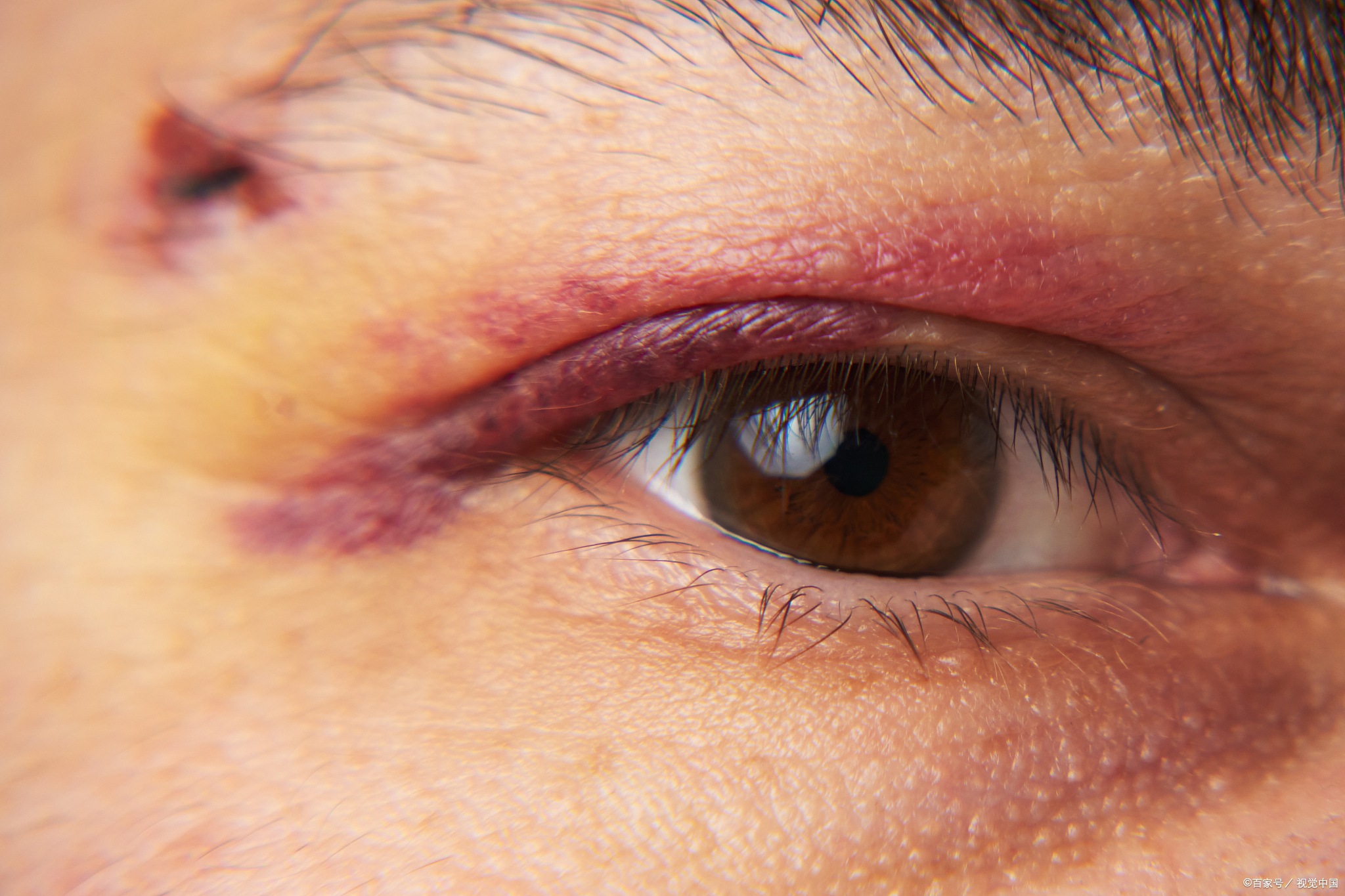 出现肿胀是正常现象,快速消肿能缩短恢复期,让眼睛更快呈现自然状态