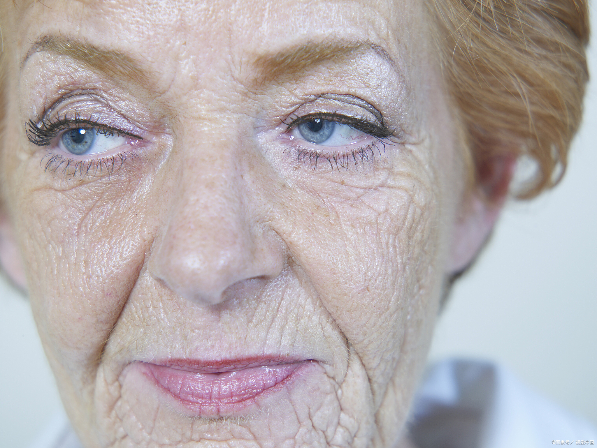 皱纹的类型:动态和静态皱纹的区别  皱纹是随着年龄的增长而出现在