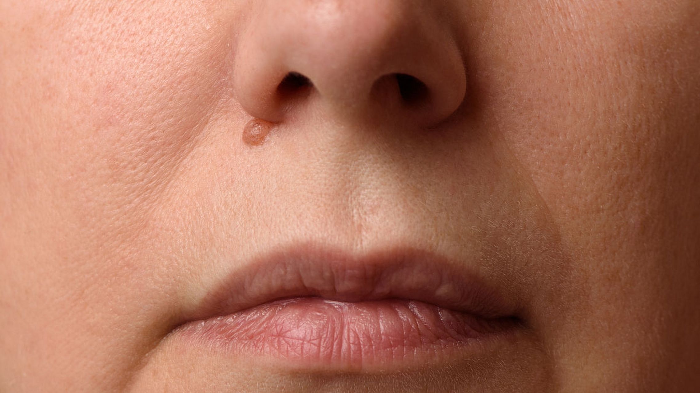 脸上的痣图片及全解  痣是皮肤上的色素斑块,通常由黑色素细胞聚集而