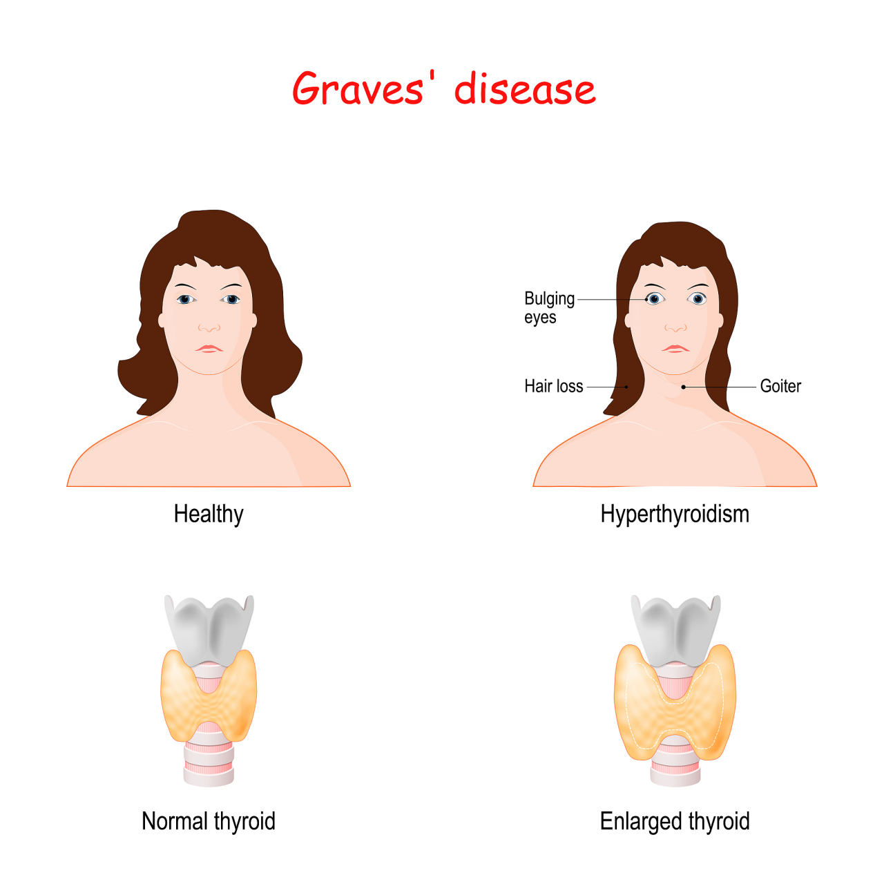 正常脖子和甲状腺脖子图片