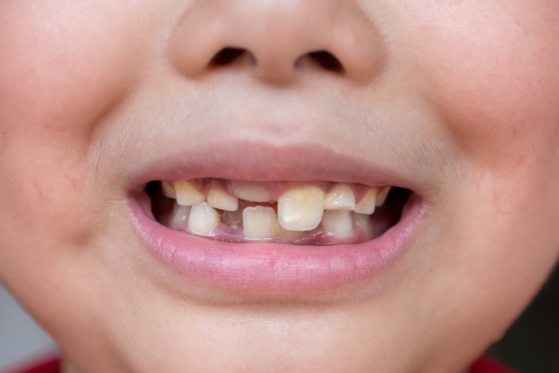 牙齿为什么会长歪?