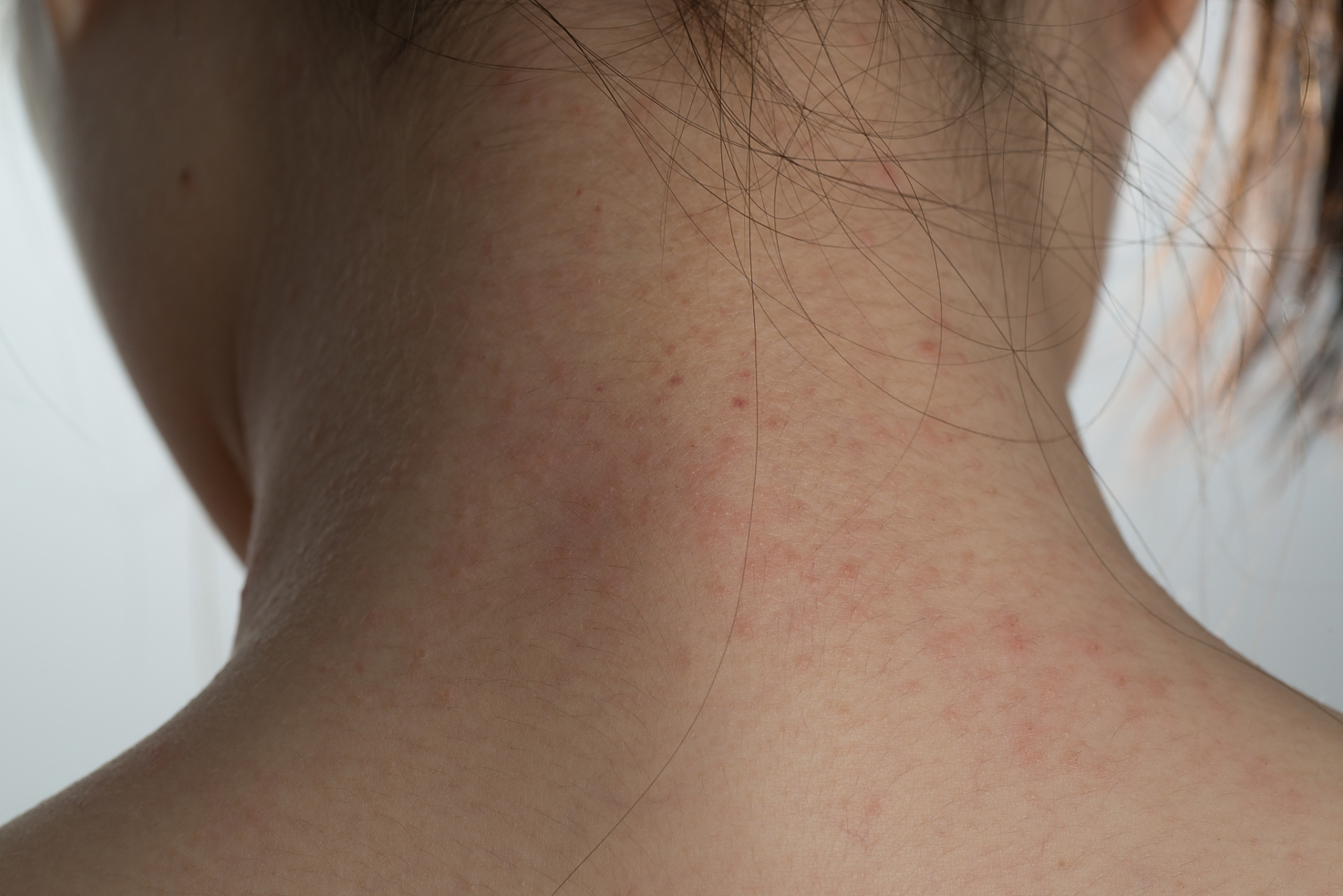 这种过敏反应是因为阳光中的紫外线损伤了皮肤细胞,引起免疫系统的