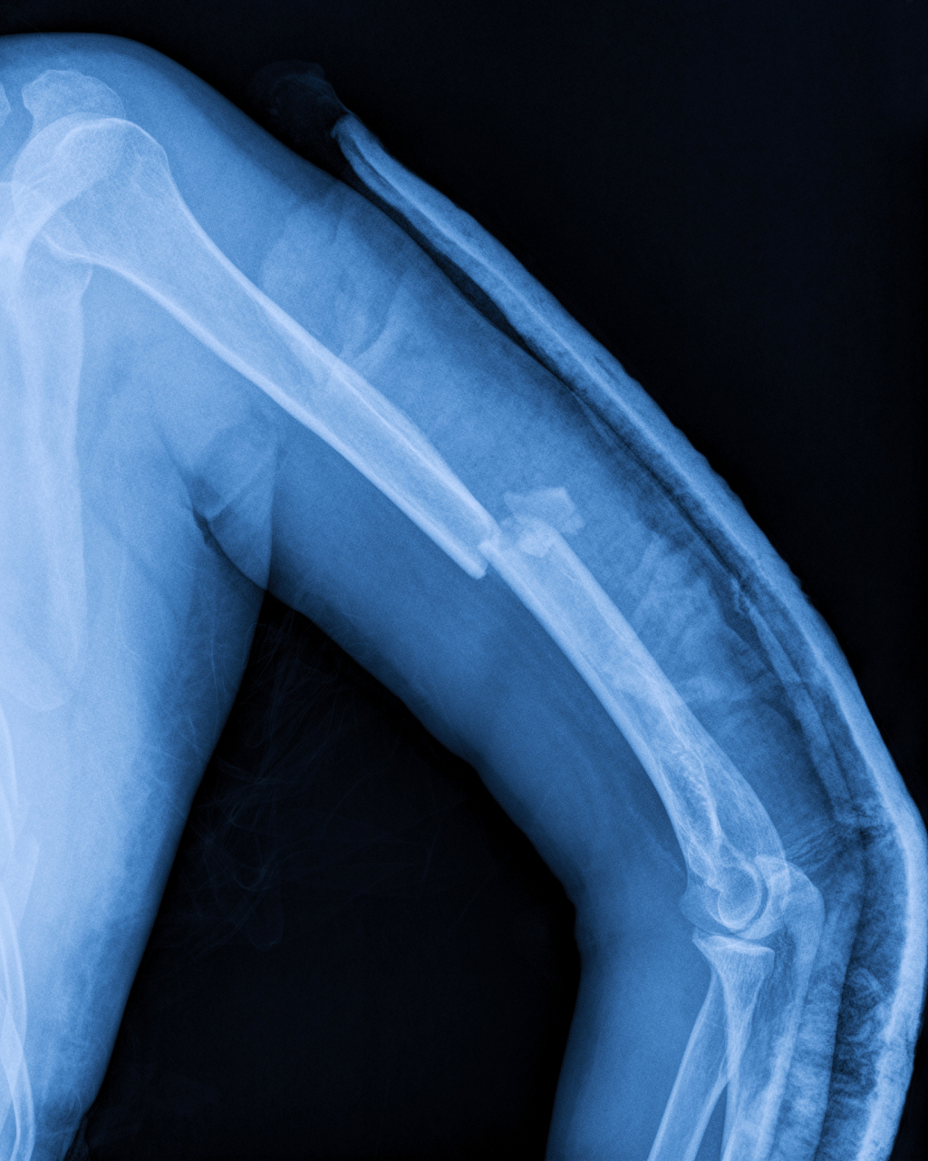 99开放性骨折是指骨折时,覆盖骨折部位的皮肤及皮下软组织发生松怂