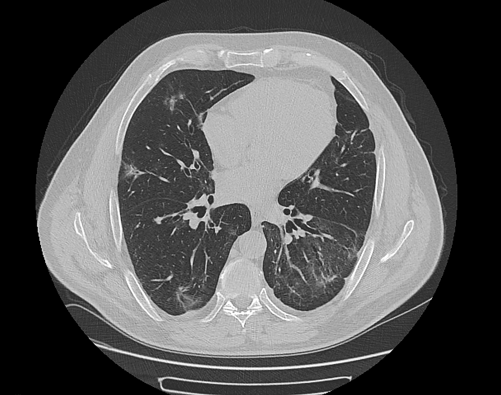 影响肺结节治疗方法选择的因素,你都知道有哪些吗?