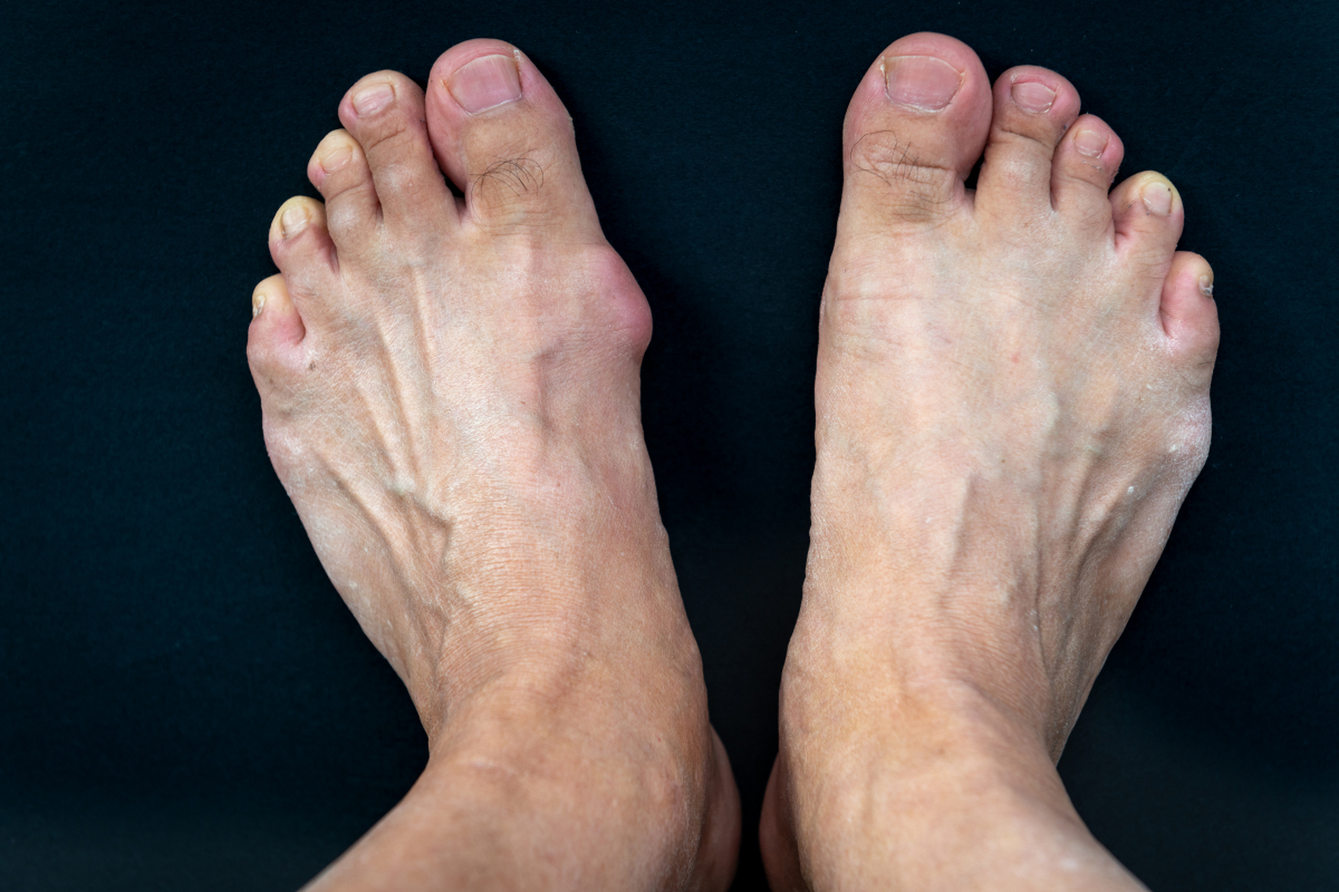 【患者自述】  我是一名大学生,我的母亲的拇指外翻,遗传给了我,之前