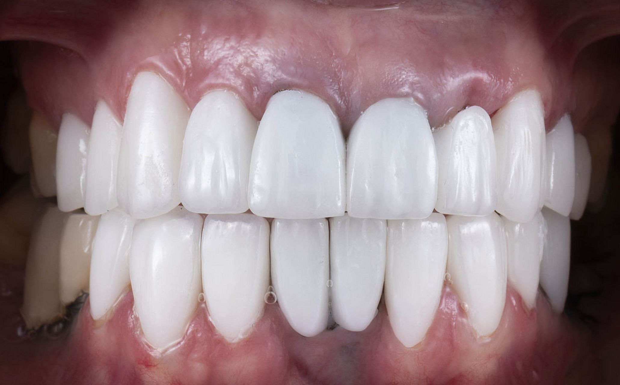 门牙做烤瓷牙有其利弊之处.它的优点是美观,并不妨碍社交.