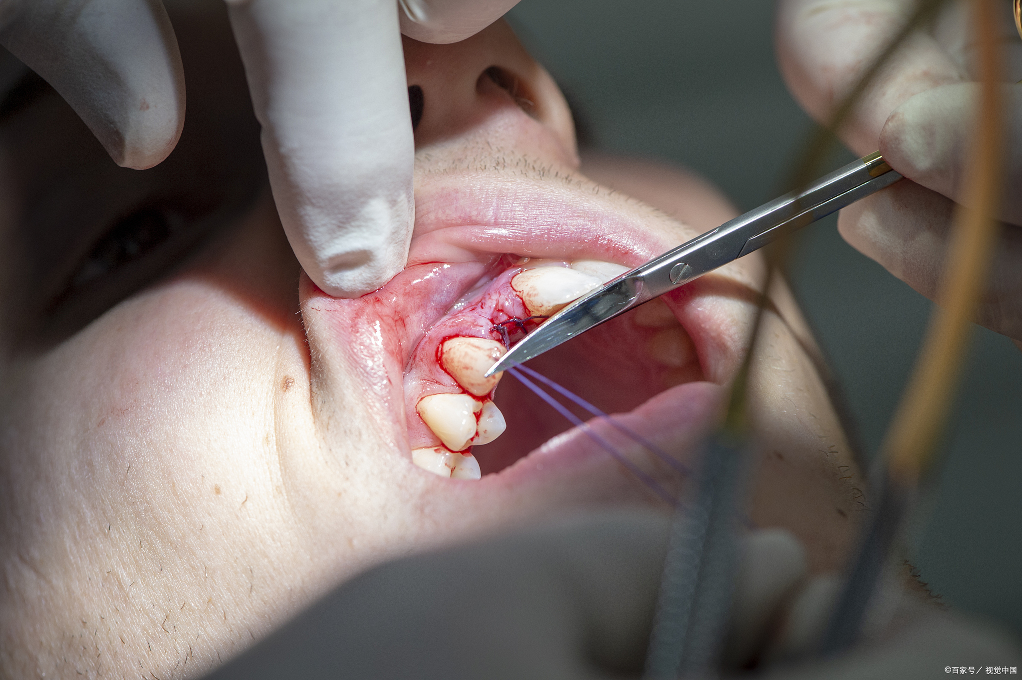 智齿冠周炎的症状,诊断和治疗方法