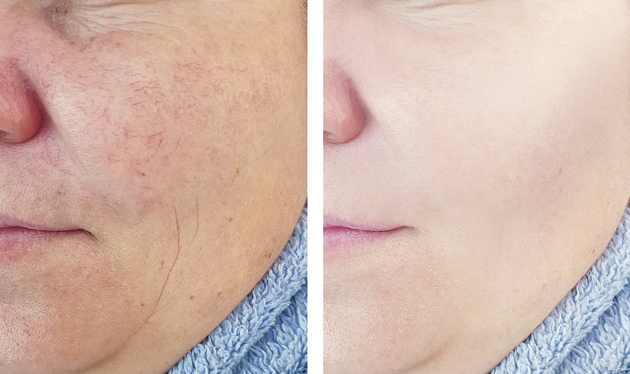 为什么明星不激光祛斑