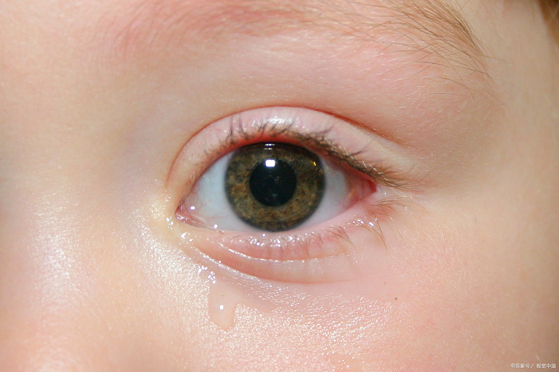 正常"小角膜"与圆锥角膜的角膜地形图容易误判,警报也不准!