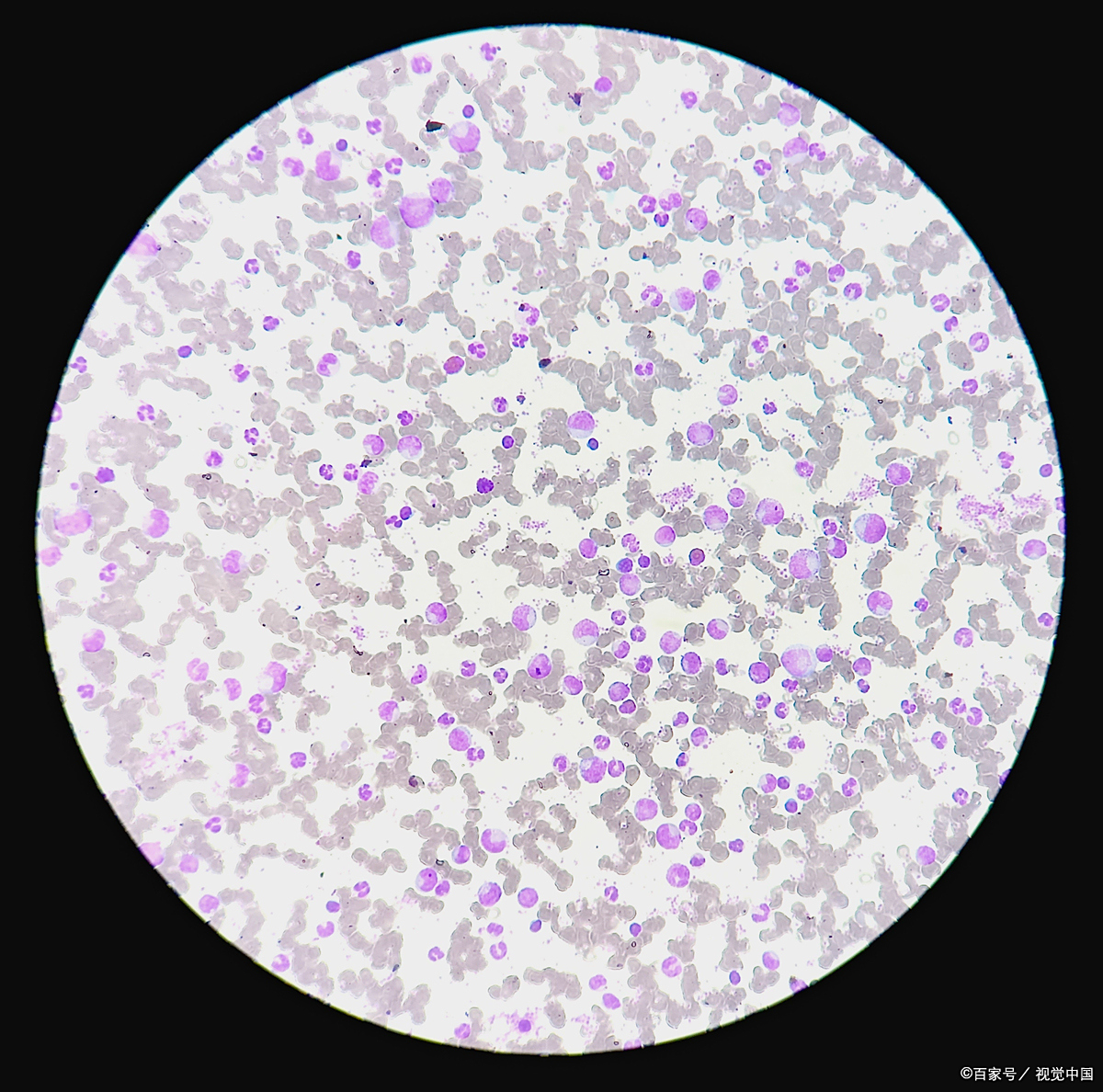 镜检白细胞高应该怎么处理