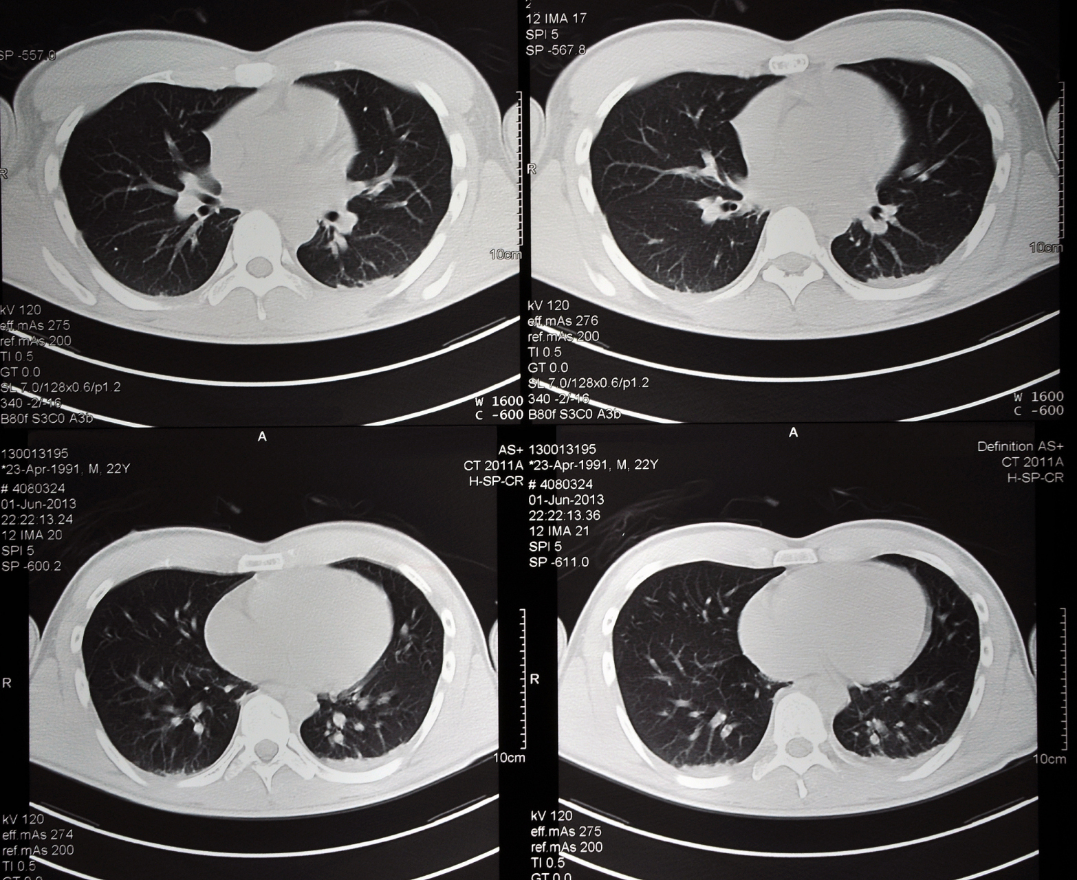 支气管炎ct影像学表现为双肺纹理增粗,增多,纹理紊乱,双肺斑点状