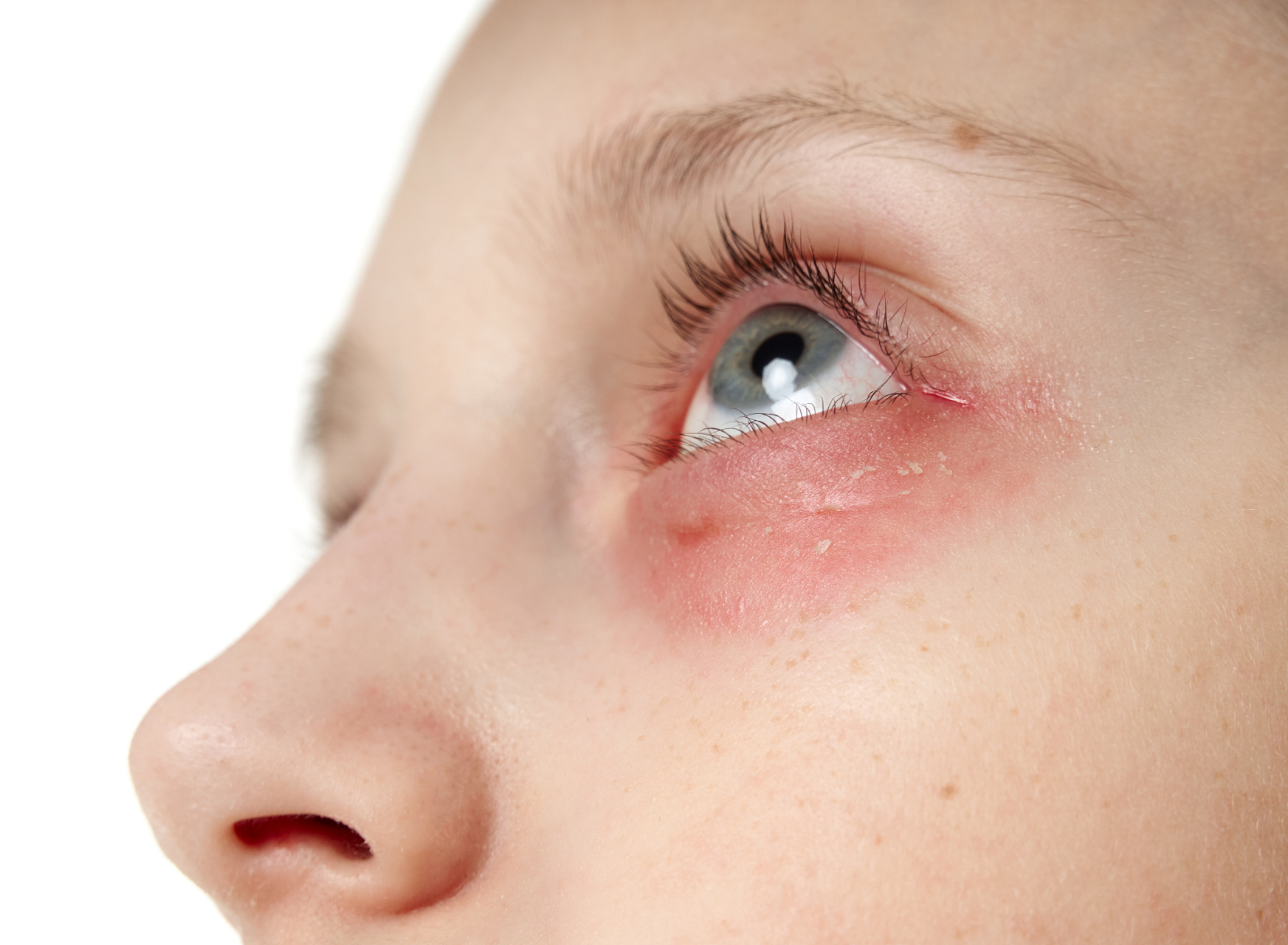 眼部过敏的明显表现和缓解办法  眼部过敏是一种常见的过敏反应,通常