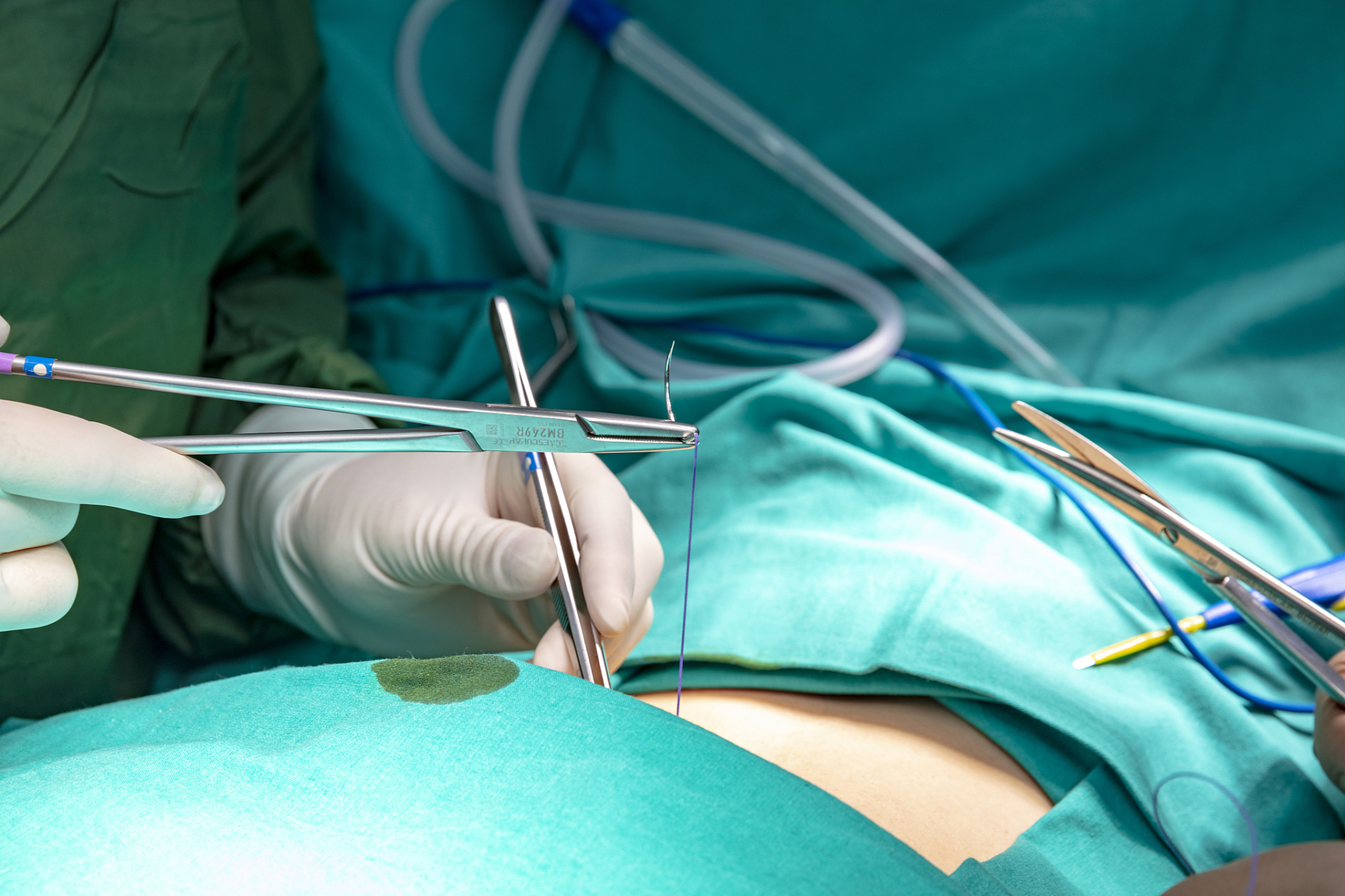 为什么胆结石患者不应该做保胆取石手术?这是一个非常重要的问题.