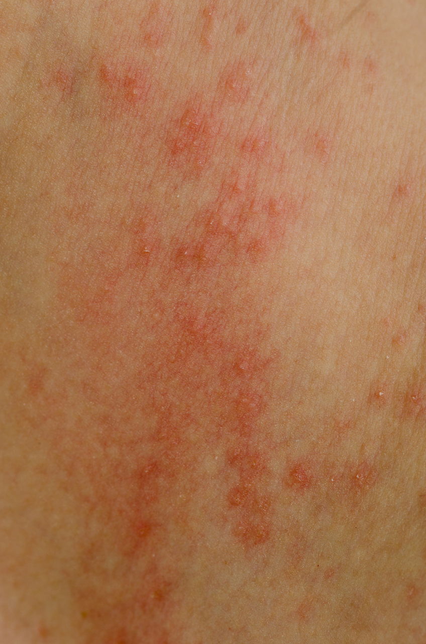 秋天皮肤过敏红痒怎么办 #医美科普挑战赛# #皮肤过敏#   1,远离过敏