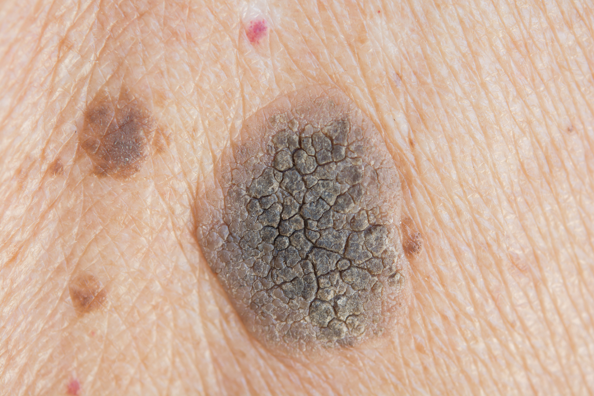 对于普通人而言,为了降低患上黑色素瘤的风险,有以下几点建议:  1. 尽