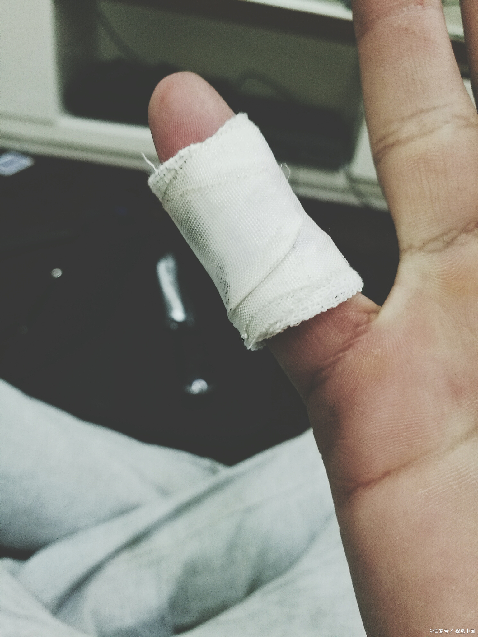 手指受伤后,即使肿胀还能活动,也不能完全排除骨折的可能性