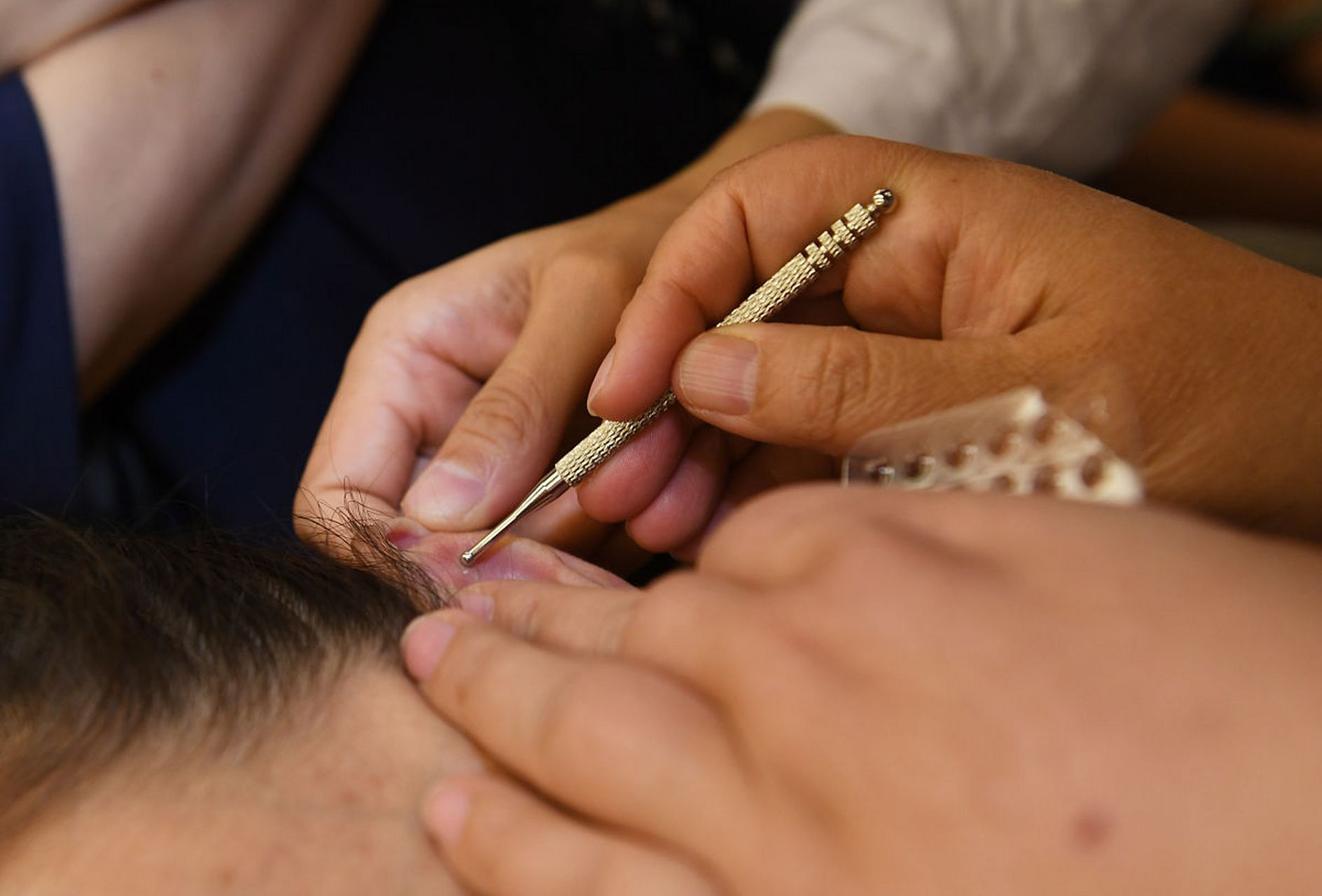 在改善情绪波动方面,耳穴疗法也有其独特的作用.