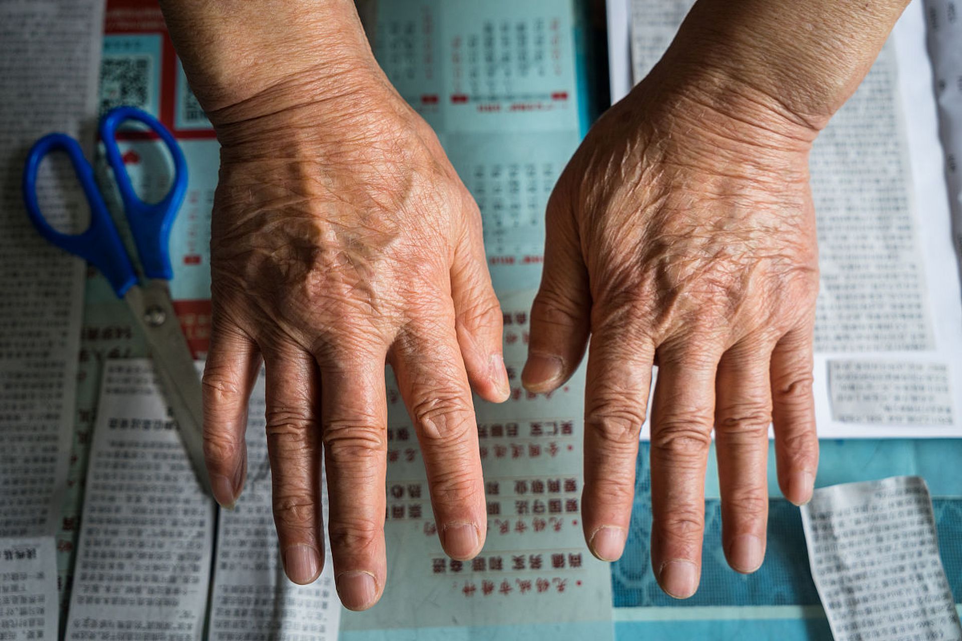 类风湿关节炎导致手指关节变形的治疗方法?