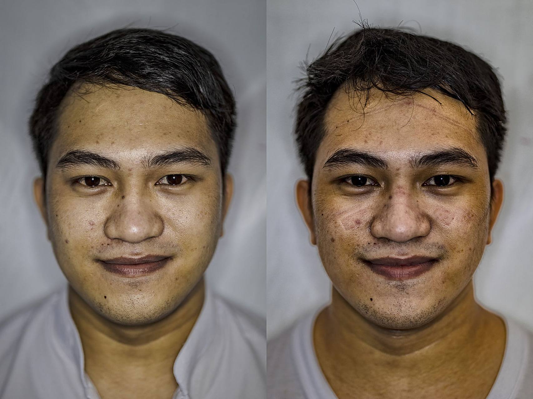 从外形上看:蒜头鼻的外形是鼻头宽厚,而且鼻翼宽大,从外观上看