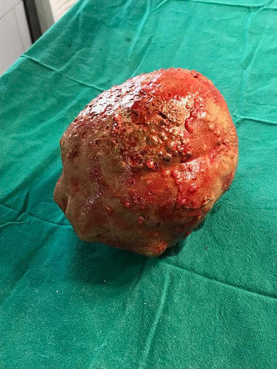 错构瘤会癌变吗  错构瘤有可能会发生癌变,但是这种癌变发生的风险是