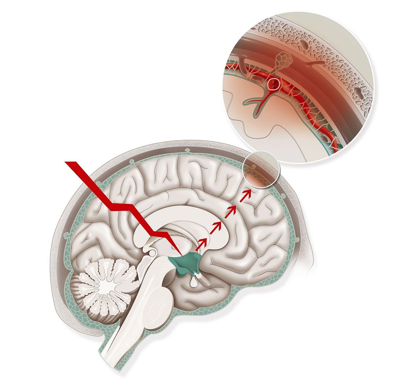 脑白质脱髓鞘改变怎么治疗?