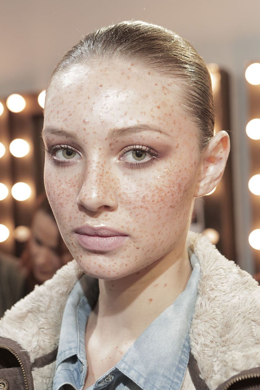 11566 雀斑是一种常见的色素沉着病,常常在皮肤表面形成小的