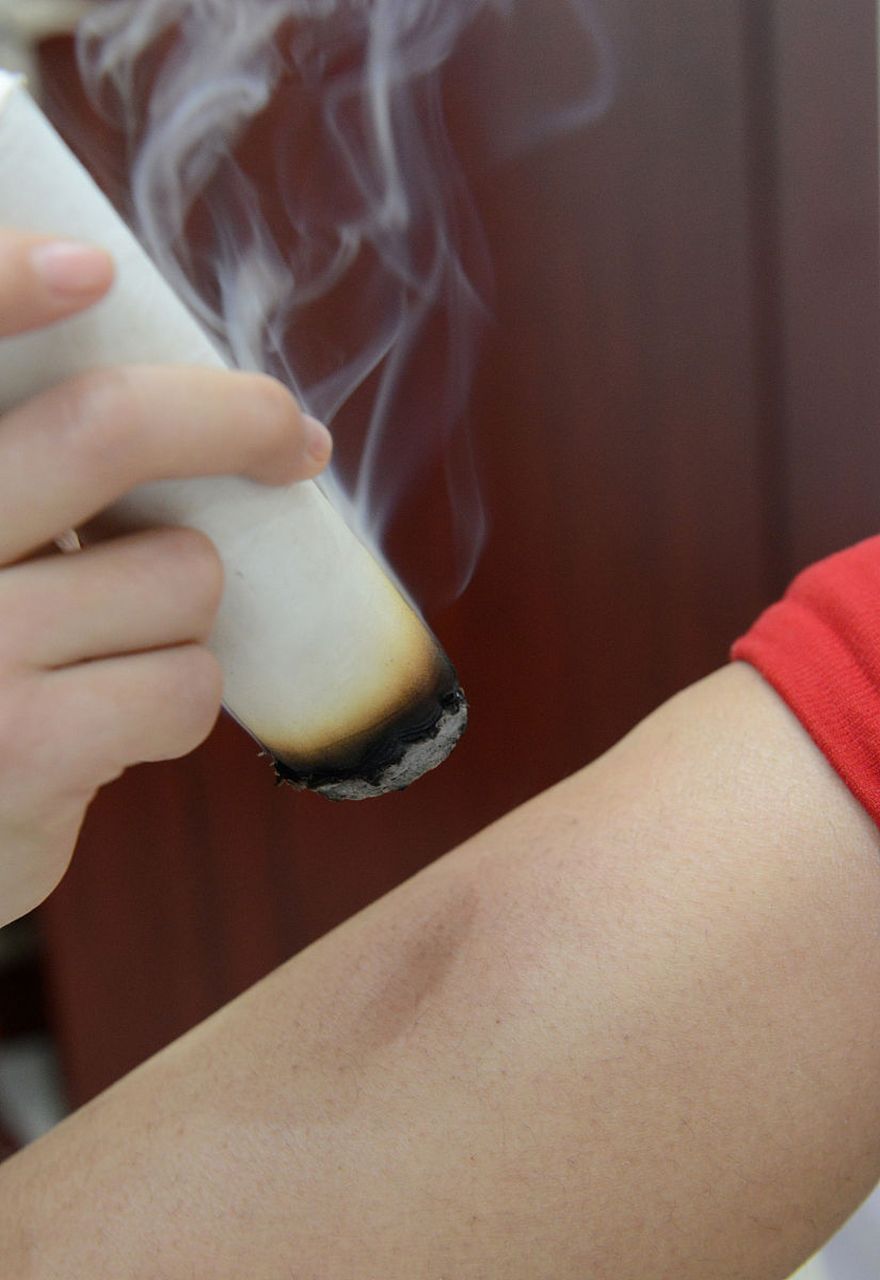 老年人眩晕用压炙  压灸是艾灸疗法中的— 种,可使热力迅速直达患处